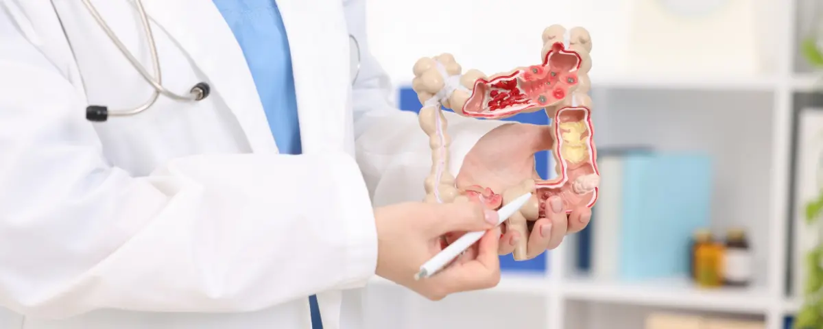 Darmkanker Mannen; dokter met deel van nepdarm in de hand om tumor te duiden in het gebied.